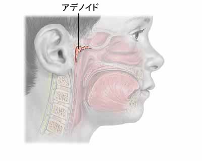 アデノイド そえじま矯正歯科